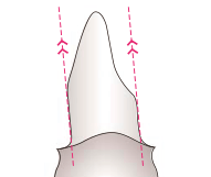 非テーバー支台