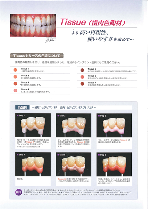 ティシュ陶材の色調・使用例