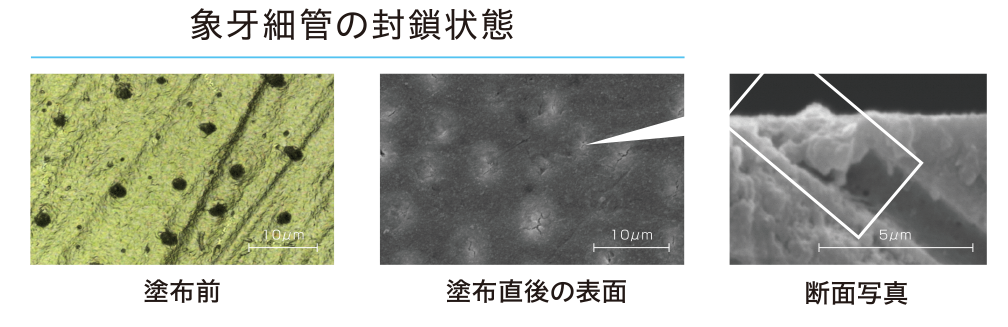 象牙細管の封鎖状態